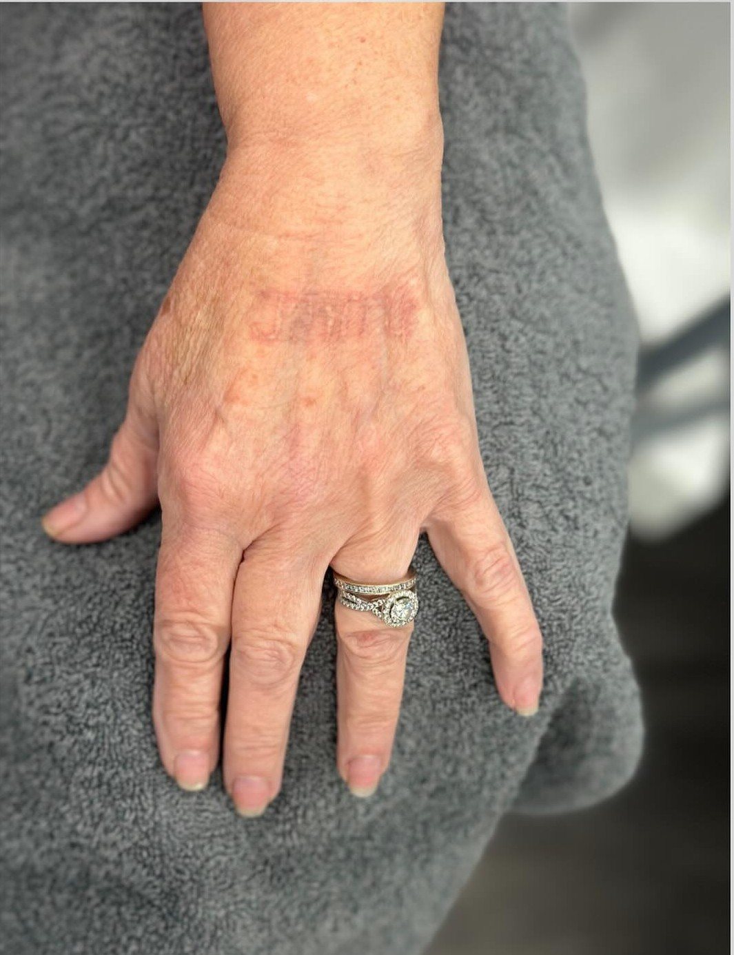 After a course of laser tattoo removal at Bright Smiles Beauty, Bridgwater